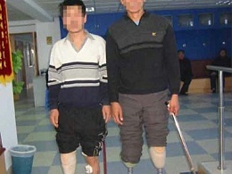 小腿假肢穿戴