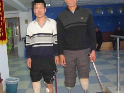 小腿假肢穿戴